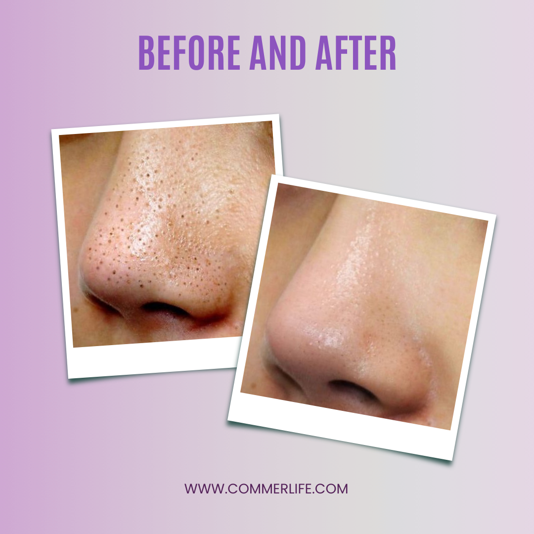 Visible Blackhead Remover