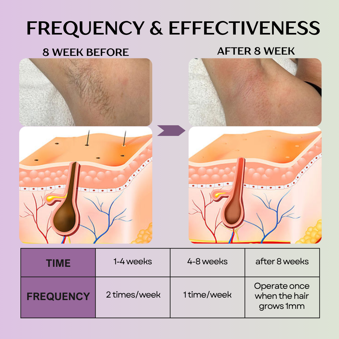 Laser hair removal device at home