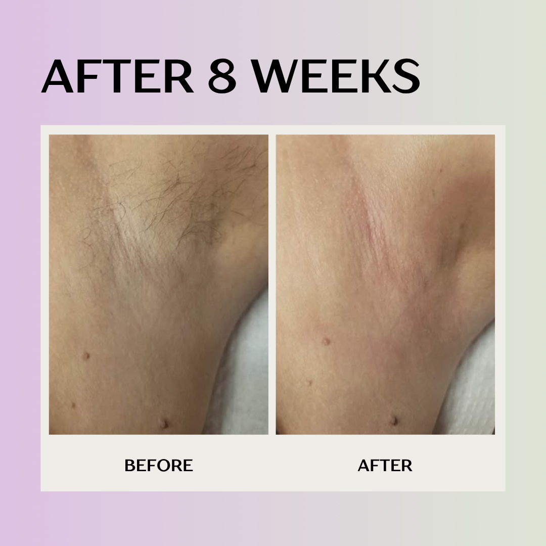 Laser hair removal device at home