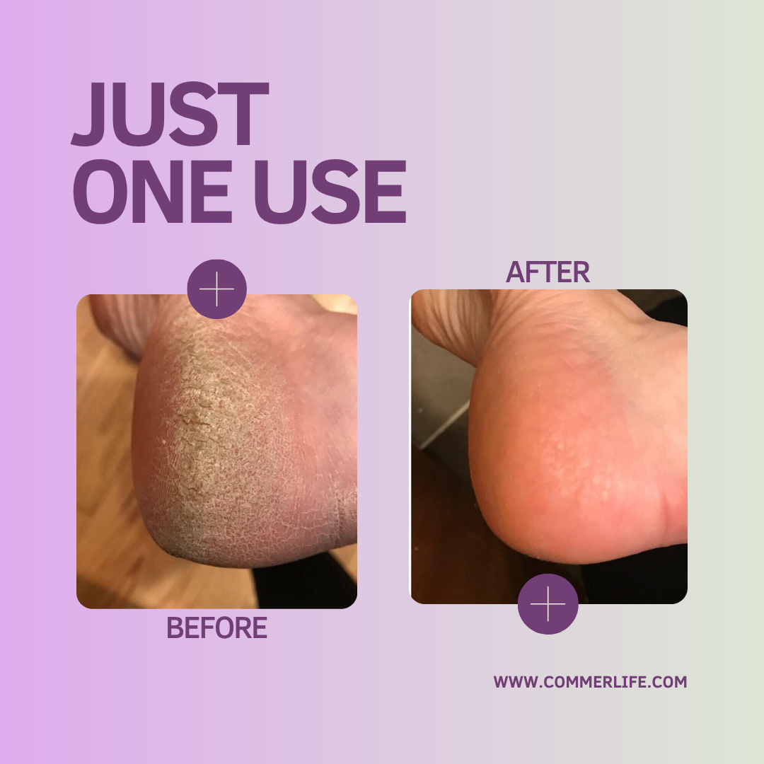 Electric Foot Callus Remover